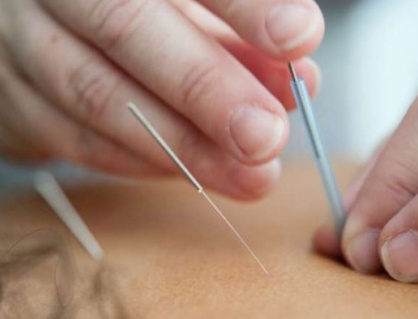 Châm cứu giúp bệnh nhân ung thư vú vượt qua chứng 'sương mù não'