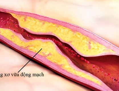 Yếu tố nguy cơ gây xơ vữa động mạch nên biết để phòng ngừa