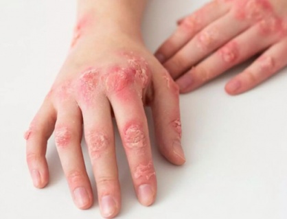 Người bệnh lupus ban đỏ nên ăn gì để kiểm soát triệu chứng tốt?