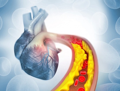 Tăng huyết áp kèm cholesterol cao: “Bộ đôi” đẩy nhanh xơ vữa mạch