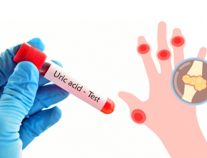 8 thói quen nhỏ giúp kiểm soát acid uric cao