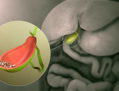 Tán sỏi qua da dễ tái phát phải làm sao?