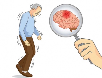 Bị run tay do thoái hóa chất trắng có dùng TPBVSK Vương Lão Kiện được không?