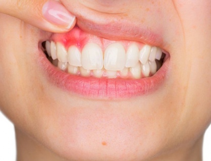 “Thủ phạm” gây viêm lợi và cách phòng ngừa thế nào?