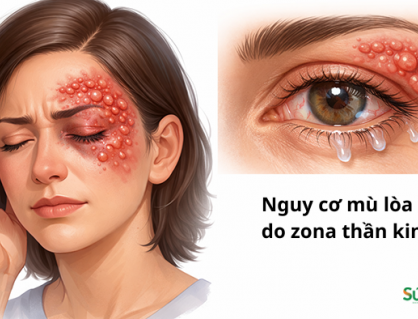 Nguy cơ mù lòa do zona thần kinh