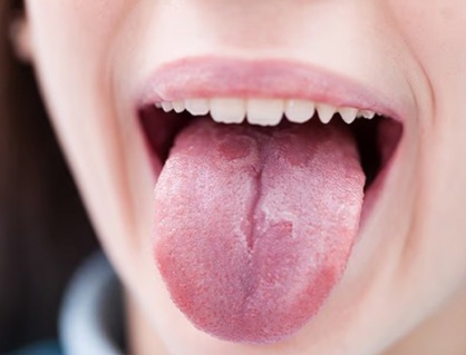 Thủ phạm “quen mặt” tăng nguy cơ ung thư miệng lên 50%