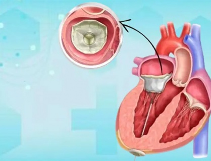 Bệnh hở van tim và tim to có chữa khỏi được không?