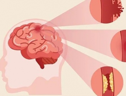 Dấu hiệu tai biến mạch máu não thường bị bỏ qua 
