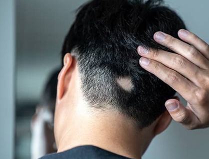Lầm tưởng thường gặp về chứng rụng tóc từng mảng