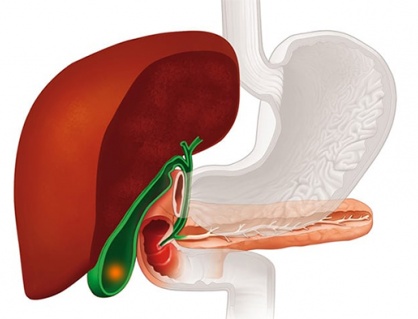 Sỏi mật 25mm dùng TPBVSK Kim Đởm Khang được không?