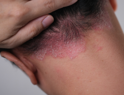 Vảy nến da đầu dễ tái phát, cải thiện ra sao?