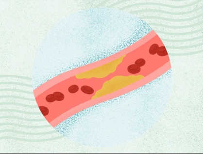 Bạn có thể mắc bệnh mạch vành dù không hề bị đau tức ngực?