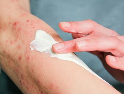 Dấu hiệu thường gặp của bệnh zona