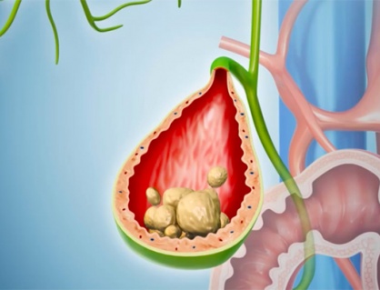 Khi nào sỏi túi mật 17mm trở thành vấn đề đáng lo ngại?