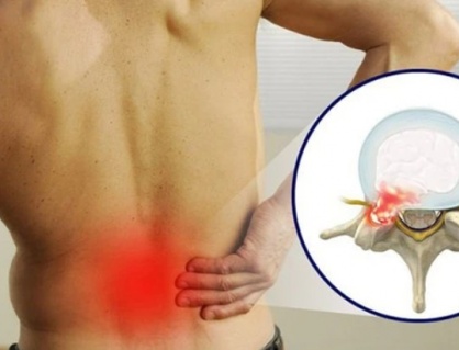 Thói quen hàng ngày khiến bệnh thoát vị đĩa đệm nặng hơn