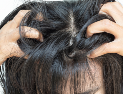 5 yếu tố âm thầm khiến vảy nến da đầu tái phát liên tục