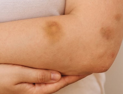 Hay bầm tím, cẩn thận thiếu vi chất