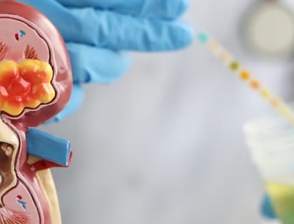 Bệnh thận mạn tính: Hiểu để dự phòng sớm!