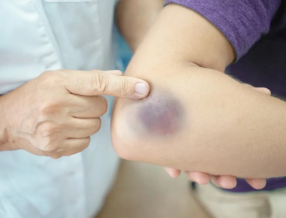 Dễ bị bầm tím, vì bạn đang thiếu loại vitamin này 