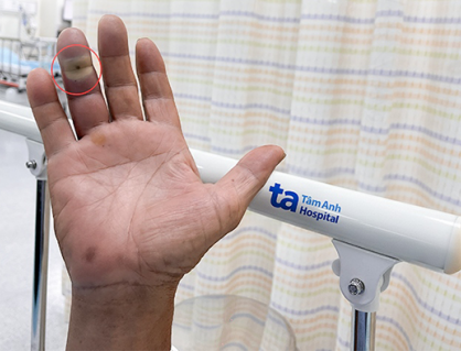 Nguy cơ nhiễm trùng nặng từ vết chó cắn