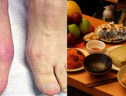 Mẹo để ngăn bệnh gout “ghé thăm” ngày Tết