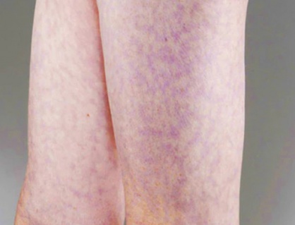 Dấu hiệu lạ trên da có thể cảnh báo vấn đề tim mạch