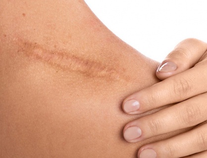 Cùng là vết thương, vì sao mặt ít sẹo hơn cơ thể?