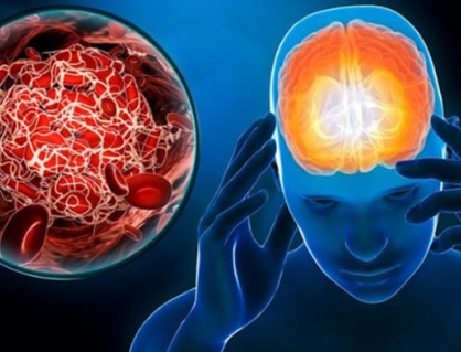 Nguyên nhân tai biến mạch máu não và cách phòng ngừa hiệu quả