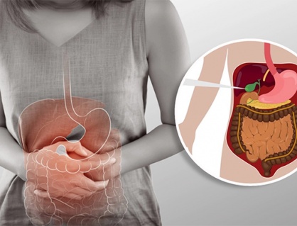 Có 3 viên sỏi mật 8mm dùng TPBVSK Kim Đởm Khang được không?