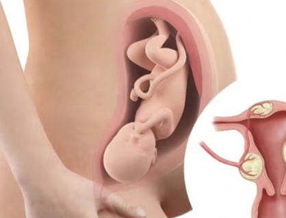 U xơ tử cung có gây khó mang thai không?