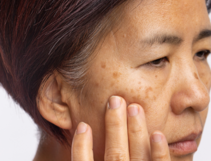 Phân biệt sạm da, tăng sắc tố và nám để bảo vệ da hiệu quả