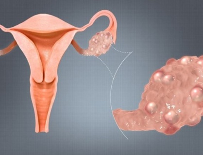 Nên làm gì khi bị u nang buồng trứng?
