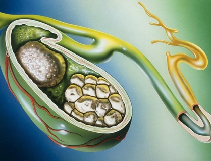 Tại sao đã mổ lấy sỏi mật 13mm vẫn tái phát sau 6 tháng?