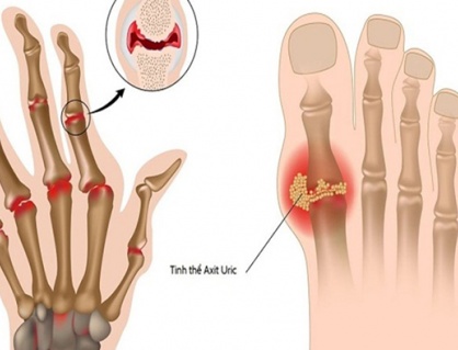 Chế độ ăn uống giúp giảm acid uric