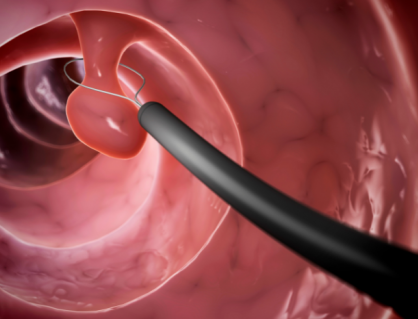 5 cách bảo vệ đại tràng, hạn chế nguy cơ ung thư từ polyp