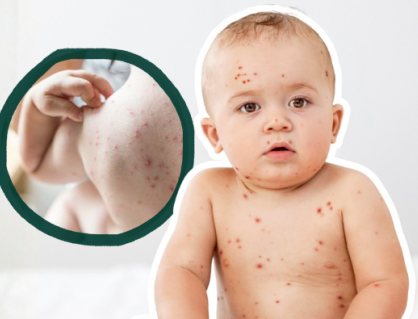 Cách giảm ngứa khi mắc thủy đậu