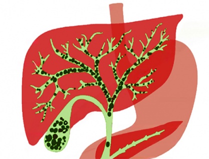 Sỏi gan 7,5mm nên mổ hay dùng cách tẩy sỏi gan 1 ngày?