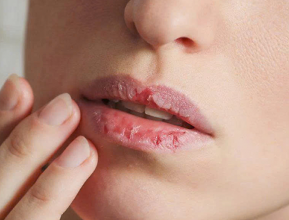 Giải pháp cải thiện tình trạng môi khô, nứt nẻ