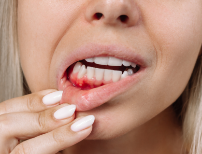 5 thói quen khiến chảy máu chân răng kéo dài
