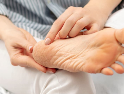 Cải thiện tình trạng nứt nẻ gót chân trong 4 bước