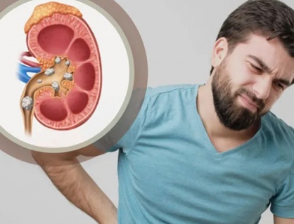 Vì sao nam giới dễ bị sỏi thận hơn nữ giới?