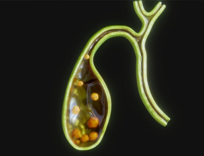 Có sỏi túi mật 21mm dùng TPBVSK Kim Đởm Khang được không?