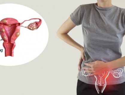 U xơ tử cung có gây hiếm muộn không?