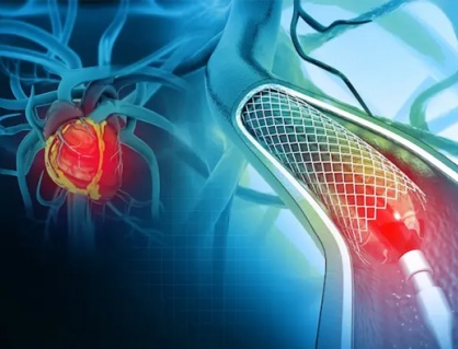 Sau can thiệp đặt stent mạch vành: Bao lâu có thể làm việc trở lại?