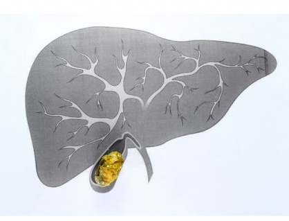 Cách tẩy sỏi gan 1 ngày có hiệu quả với sỏi 4,5mm không?