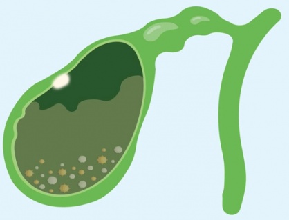 Có polyp túi mật và sỏi bùn túi mật cần cẩn trọng gì?