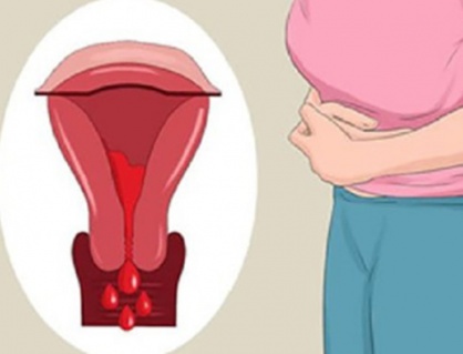 Dấu hiệu u xơ tử cung dưới niêm mạc giúp chị em “bắt” bệnh sớm