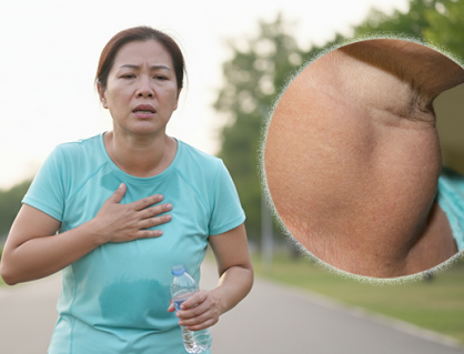 Khả năng vận động suy giảm vì bướu cổ do thiếu iod