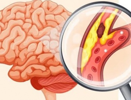 Những ai dễ bị nhồi máu não?