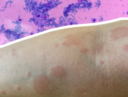 Lupus ban đỏ dạng đĩa ảnh hưởng thế nào đến cơ thể và làn da?